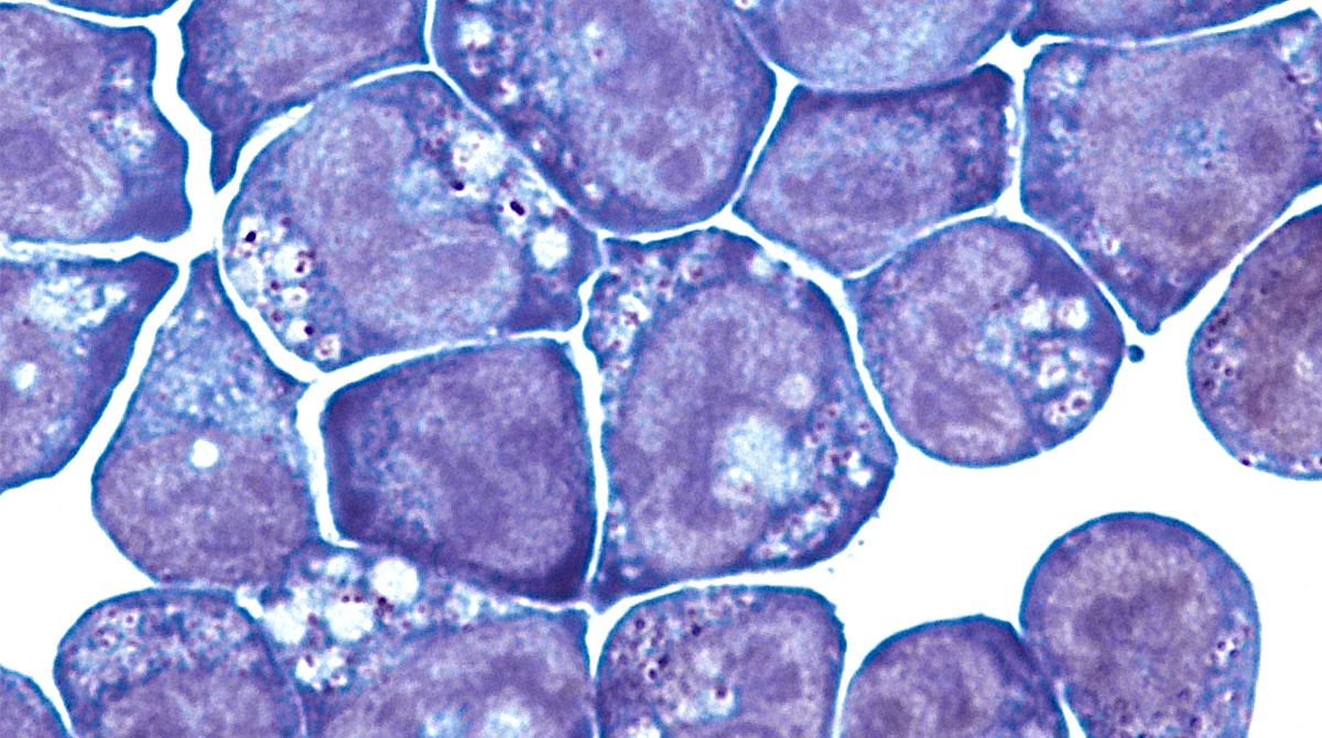 New insights into the cellular origin of aggressive acute myeloid ...