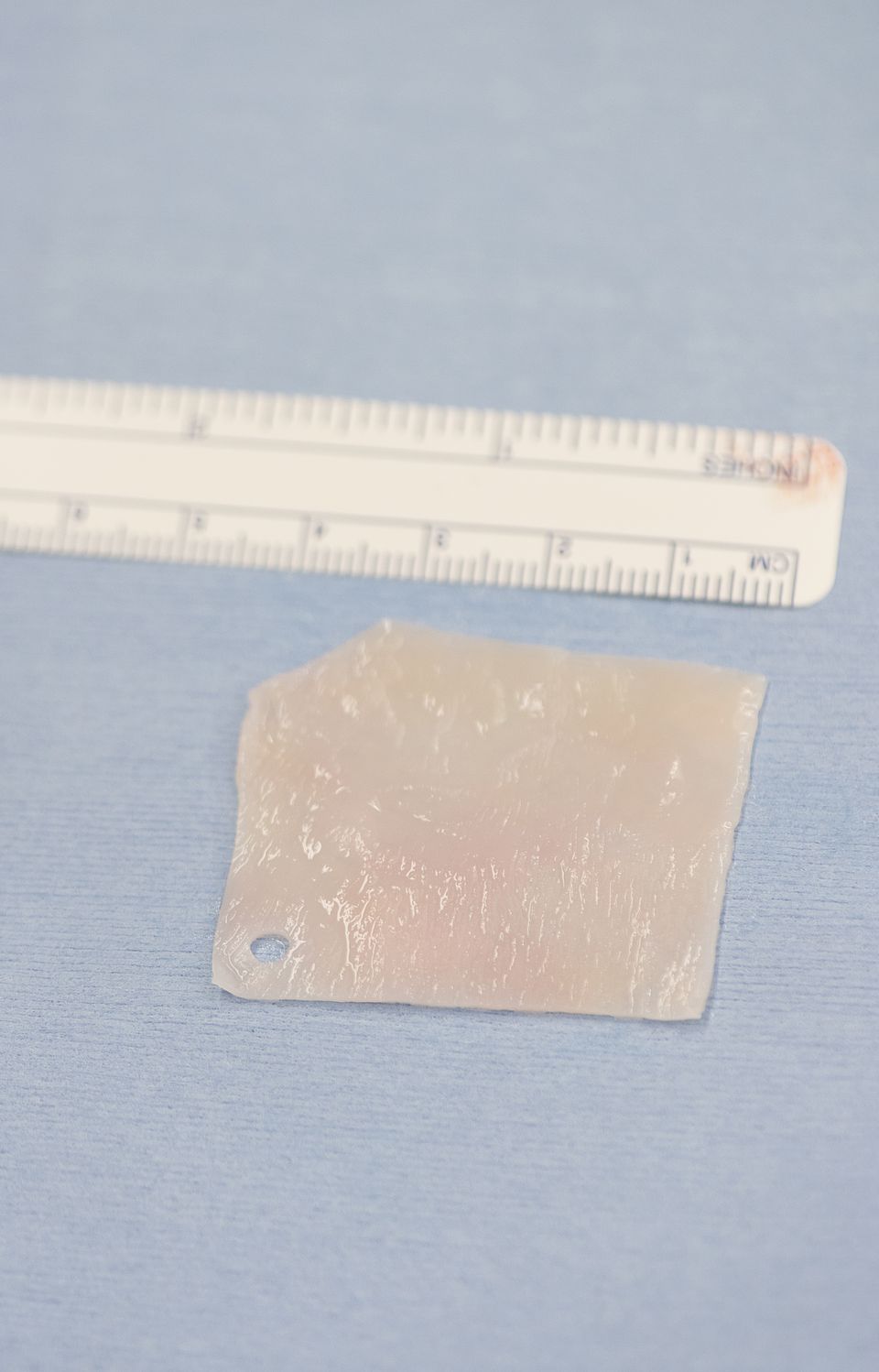 Engineered cartilage graft of about 20cm2, manufactured from a nasal cartilage biopsy .