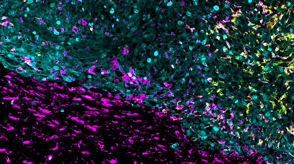 Glioblastoma: new treatment attacks brain tumors from multiple angles